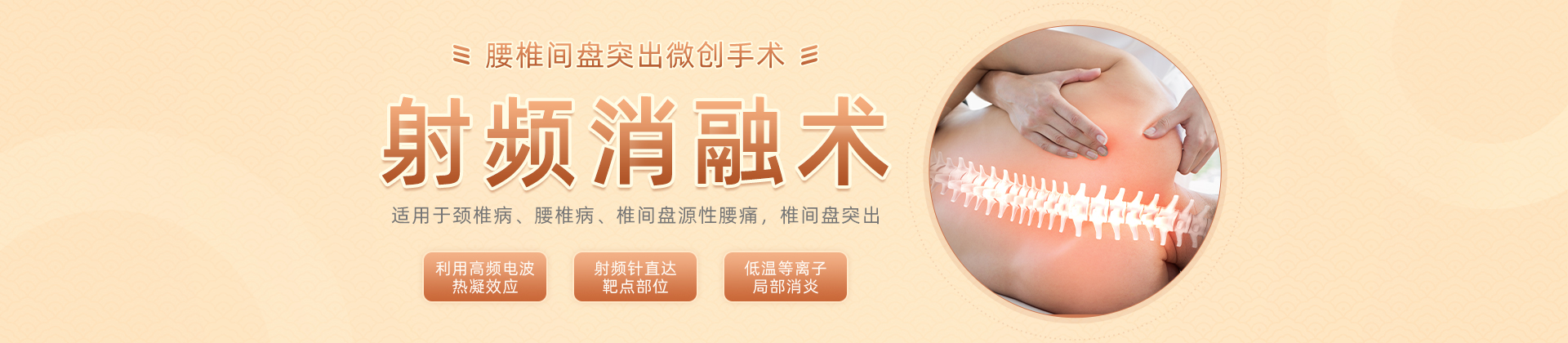 射频消融术